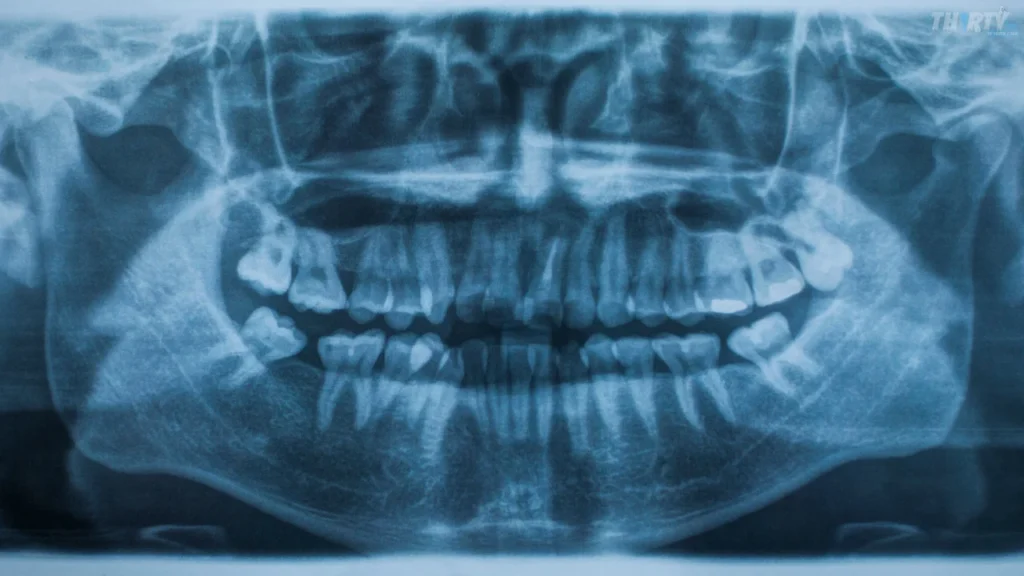 Panoramic X-ray اشعة بانوراما
