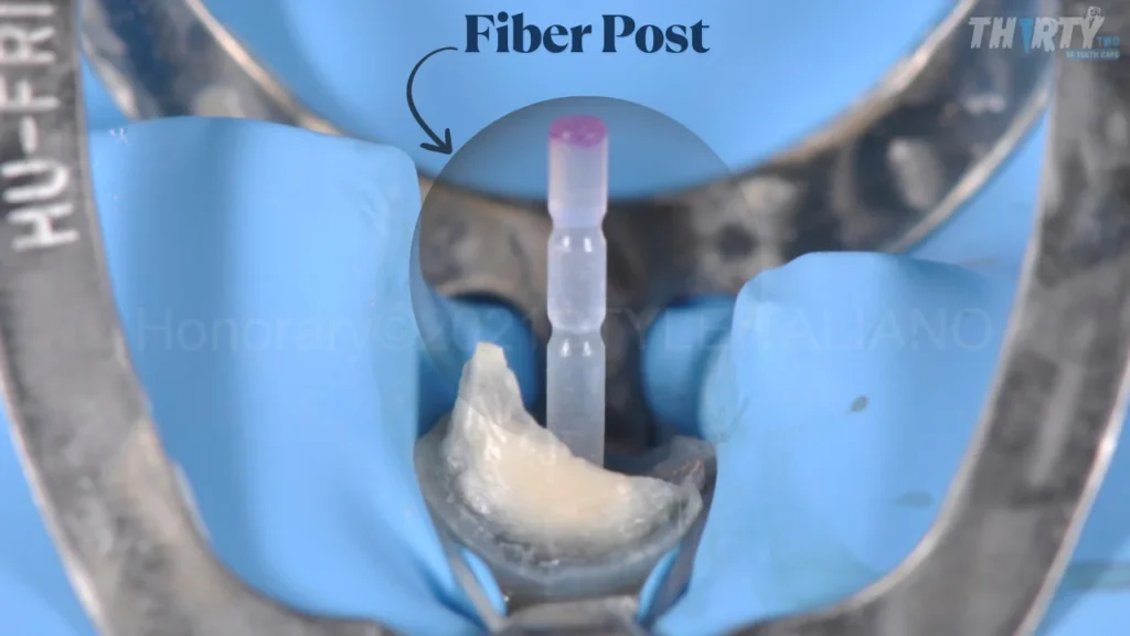 دعامة ليفية Fiber Post