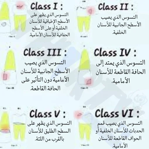 أنواع تسوس الأسنان
