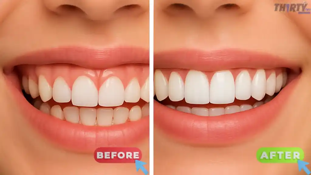 الابتسامة اللثوية (Gummy Smile): 1 الابتسامة اللثوية