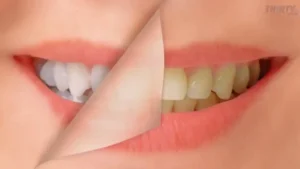 تبييض الأسنان