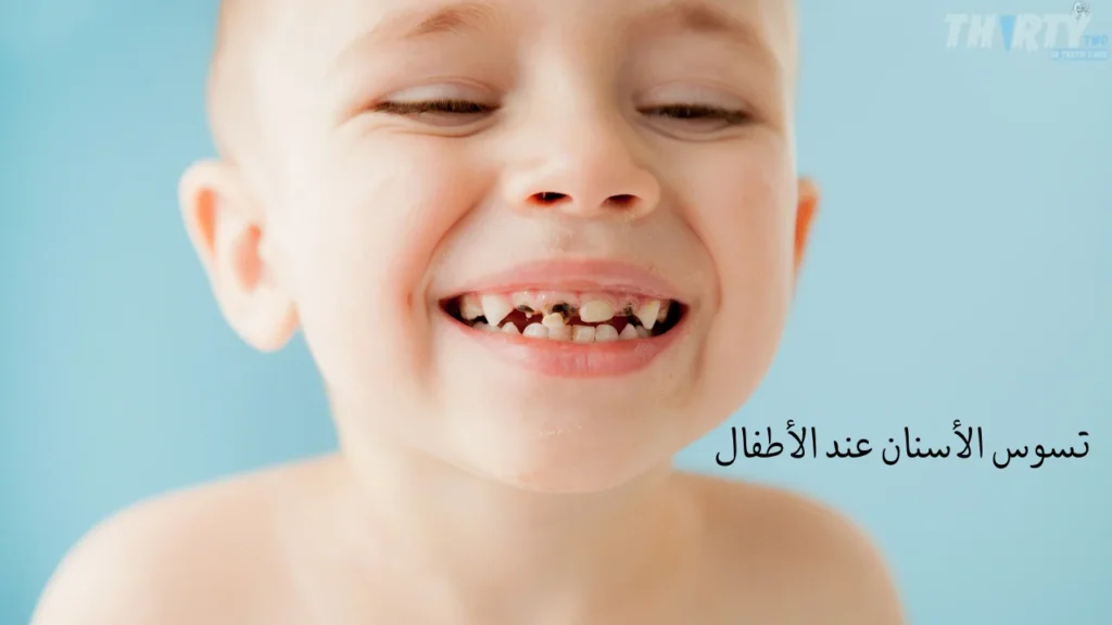 تسوس اسنان الأطفال