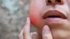 التهاب النسيج الخلوي