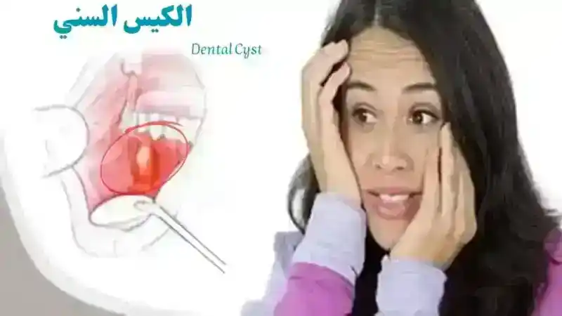 الكيس السني 