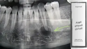 الورم الحبيبي الجذري