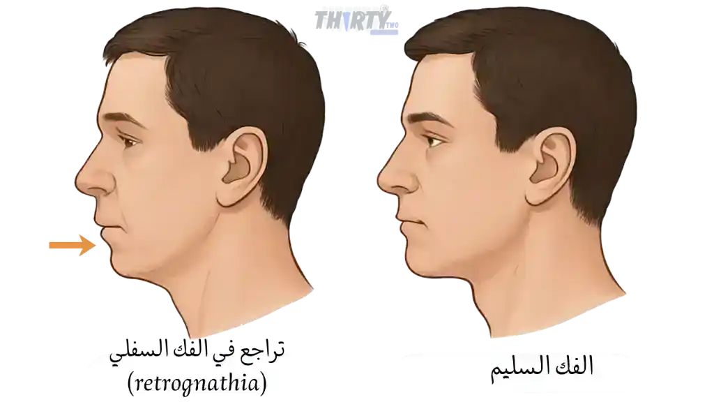 تراجع الفك السفلي