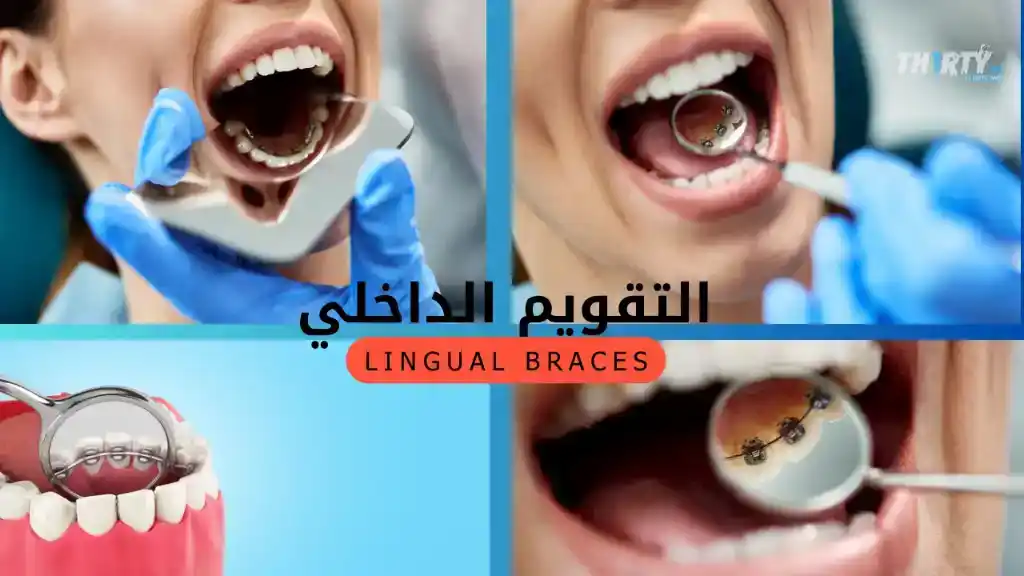 تقويم الأسنان الداخلي