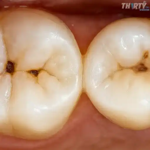 تسوس الأسنان كلاس ون