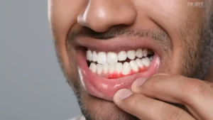 خراج الأسنان