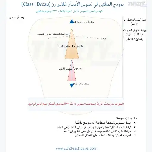 تسوس class1